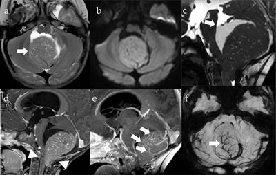 SHH medulloblastoma and very early onset of bowel polyps in a child with PTEN hamartoma tumor syndrome